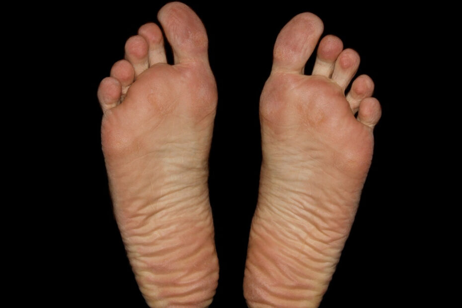 modzele na stopach - twarde zgrubienia skóry